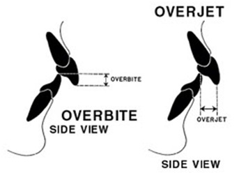 bite-correction